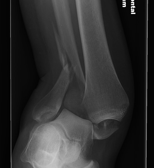 Ankle Fracture Pronation External Rotation